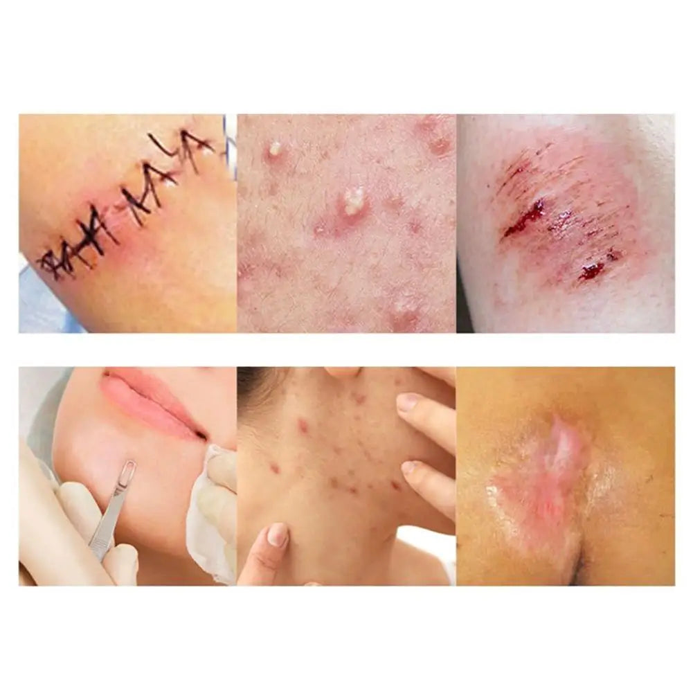 1 Roll Hydrocolloid Roll Invisible Hydrocolloid Dressing With Self-Adhesive Bed Sore Bandages For Wound Care Hydrocolloid Patch